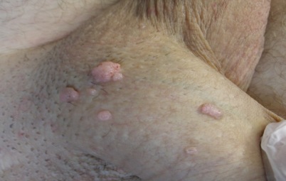 papillomavirus homme dermatologue)