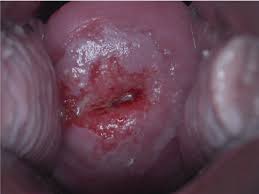 condylom col uterin paraziták és gombás fertőzések