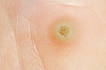 Verrue type papillomavirus. Papilloma is warts Papillomavirus verrue nez