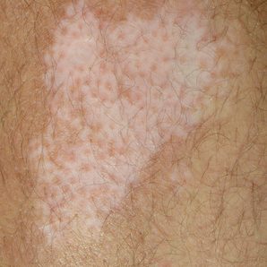 Vitiligo Spot on the Leg